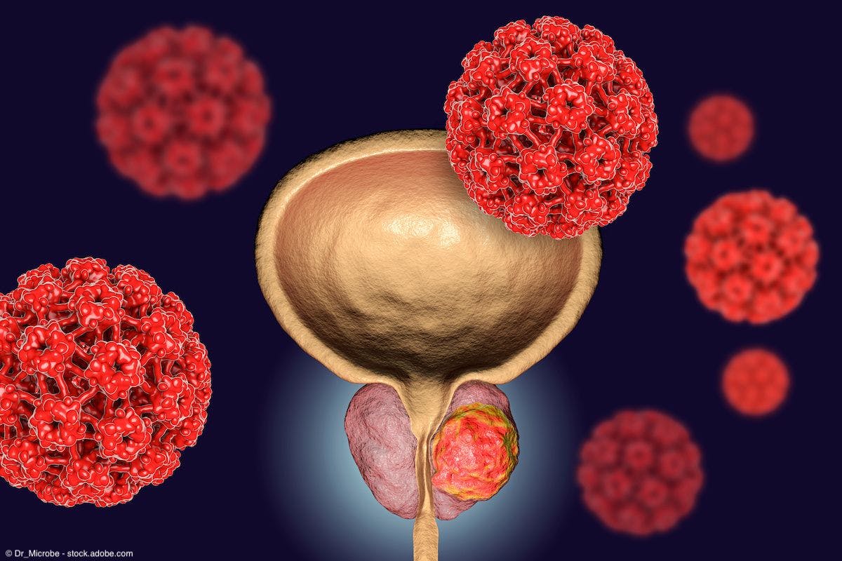 medical depiction of prostate cancer 