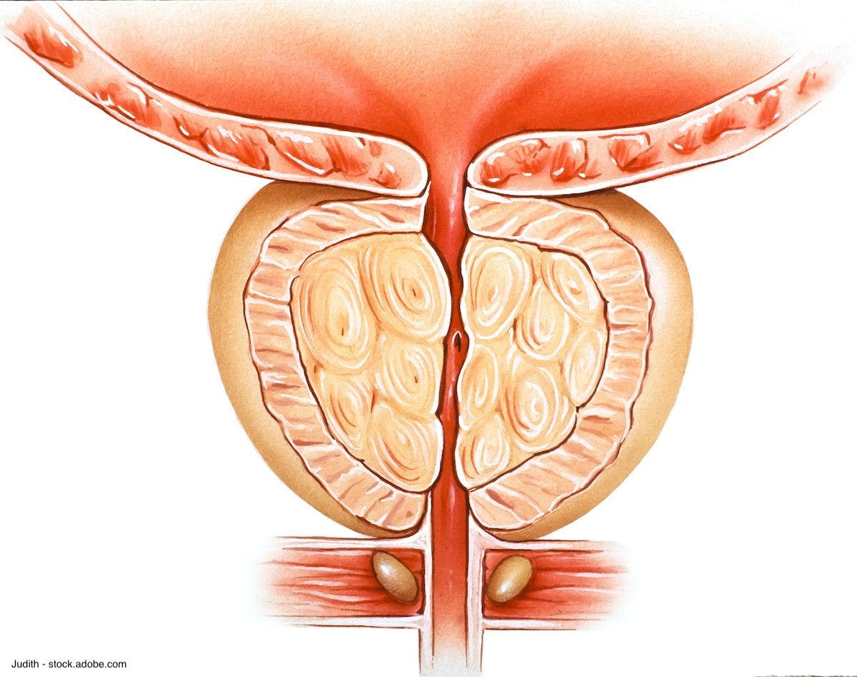 Dr. Chughtai explains how "less is more" approach has implications for BPH