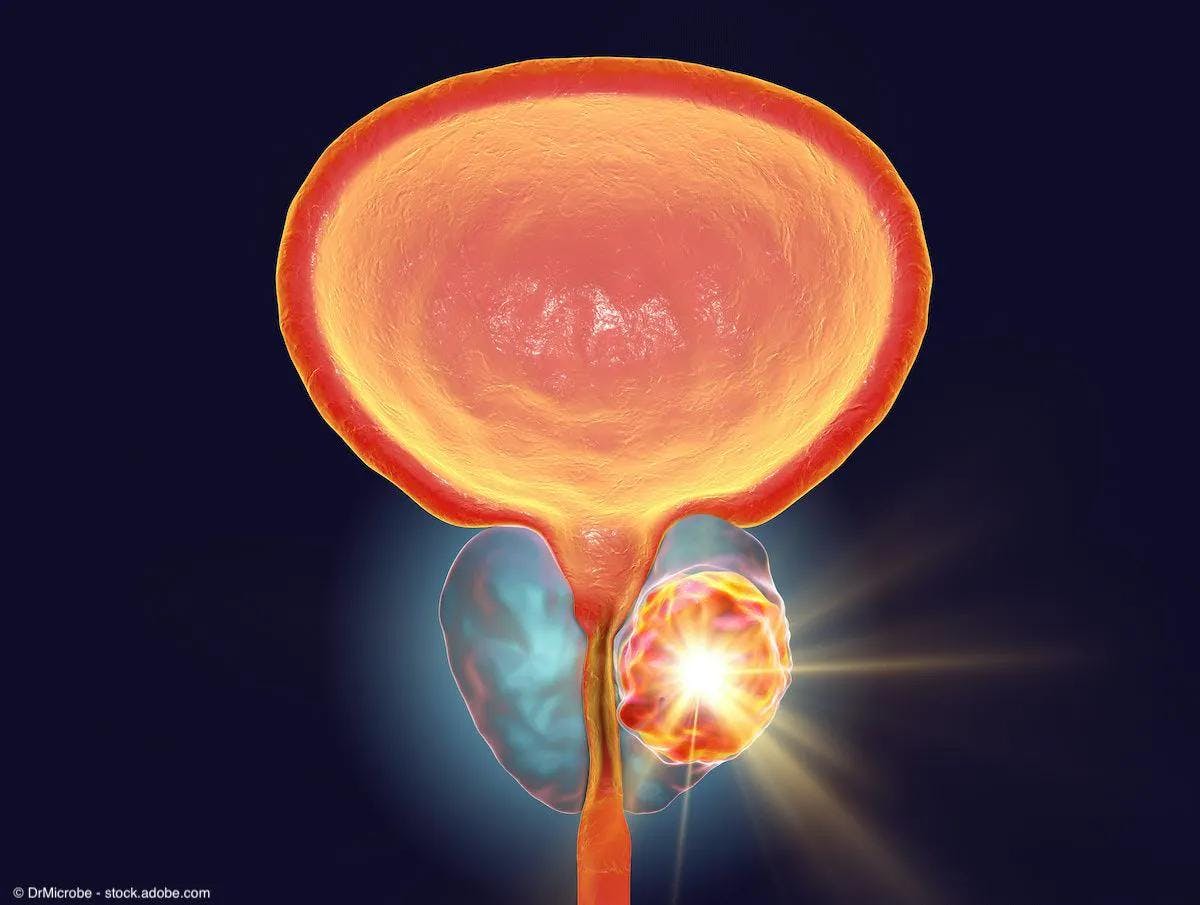 medical depiction of prostate cancer treatment