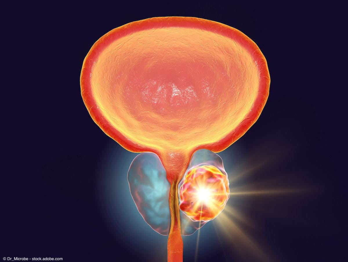 Flotufolastat F 18 shows high detection rate in patients with low PSA levels